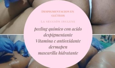 Protocolo despigmentante en gluteos con optimos resultados.